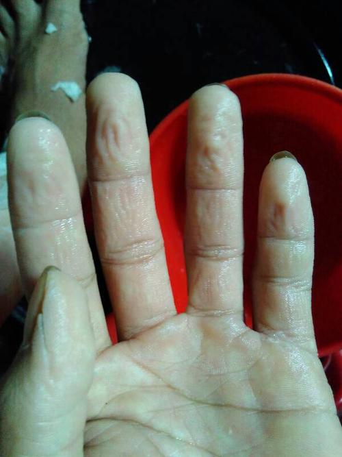 为什么手指长时间接触水如图片了皱巴巴像老严的皮肤为什么