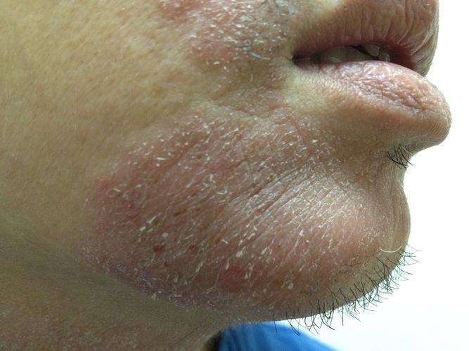 图示红斑斑块边界非常清晰(大多数异位性皮炎患者的红斑的边界不大