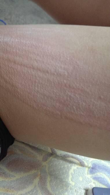 尤其是大腿跟胳膊,一抓就红,一浪一浪的,皮肤看上去跟起鸡皮疙瘩似的