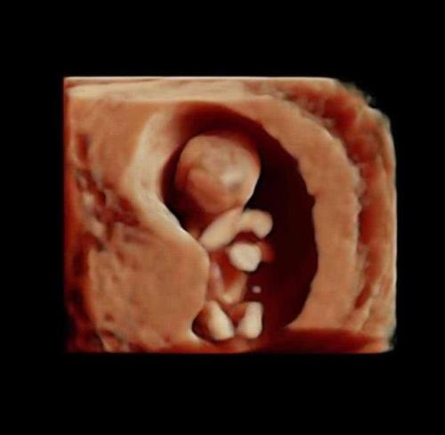 胎儿从卵泡到孕17周17张图片清晰诠释男宝女宝看得很清楚