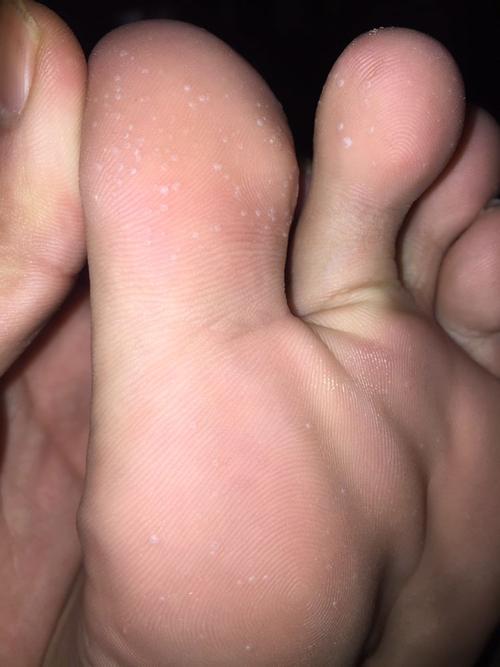 脚底上有密集的白色点点,这是什么皮肤病?