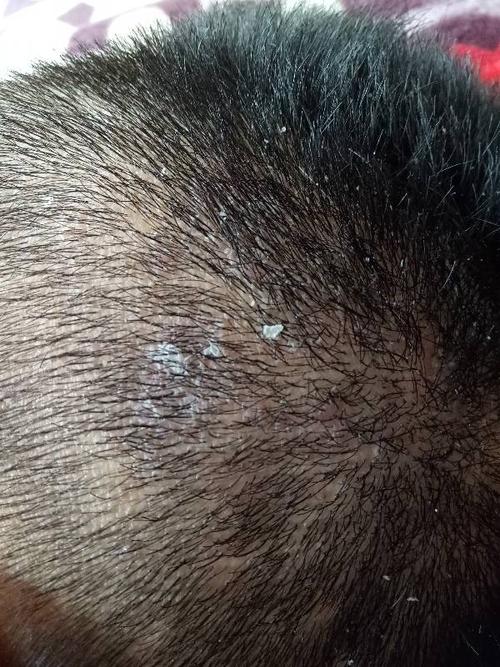 想问下我家这位是不是长头皮癣了,头皮很容易很容易长头皮屑,一天没
