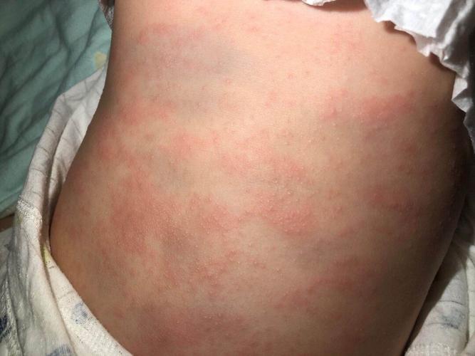 5个月大宝宝身上长满了红点,是什么?_母婴_育儿_母婴