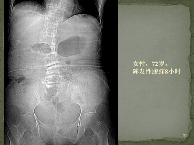 ct入门 | 肠梗阻的ct影像诊断