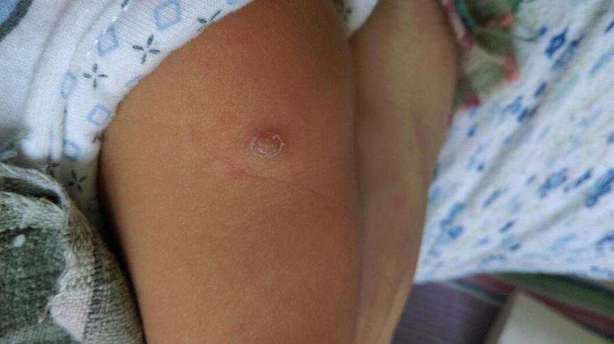 知道的宝妈帮我看看,都说是打疫苗留下的疙瘩