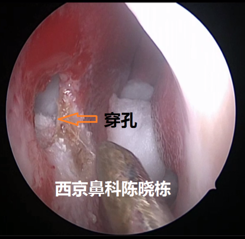 鼻中隔穿孔的治疗