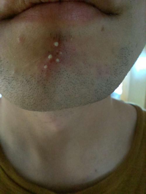 下巴上为什么总是长这样的痘痘,一两天就没了,可是经常冒出来.