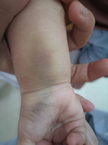 孩子身上都是淤青是怎么回事