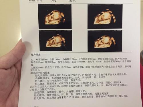 四维彩超检查!双胞胎宝贝的第一张照片好可爱哦!
