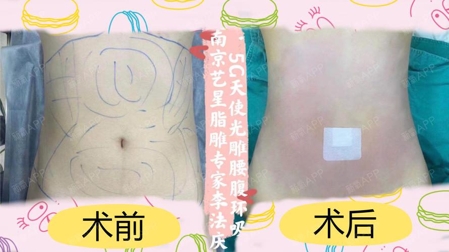 今日医美科普腰腹部吸脂是不是难度最低的吸脂术