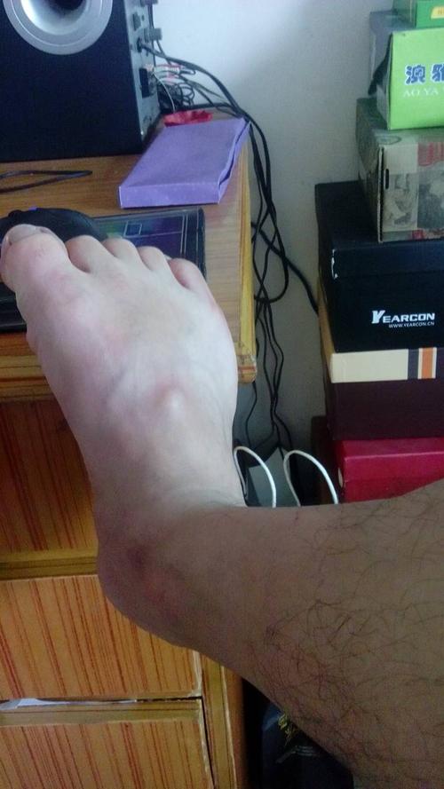 展开全部 病情分析: 你好,看你说的这个症状,那是否有长了脂肪瘤或