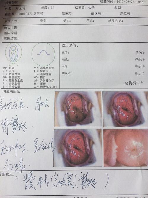 hpv16 .6 感染合并慢性宫颈炎伴糜烂 到底要不要治.