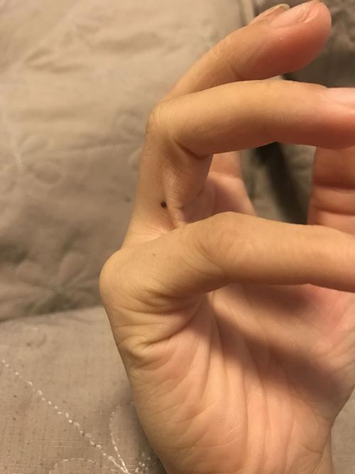 右手无名指有颗痣,在靠近小拇指那一侧,从小都有,这个