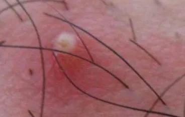 痤疮和毛囊炎完全不是一种病,正确区别,不可一概而论!