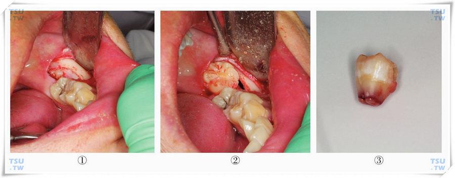 微创进行智齿的预防性拔除