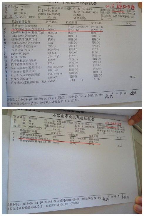 注:抗双链dna抗体是诊断sle标记抗体之一,多见于sle的活动期,抗体的