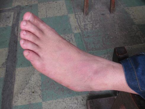 这是一例发在脚背的痛风患者.