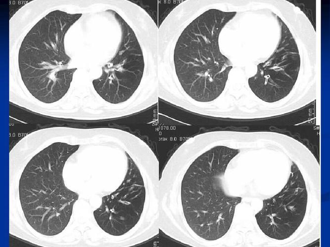 肺部常见疾病ct读片ppt