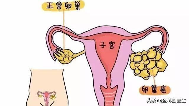 为何卵巢癌一发现多是晚期呢?