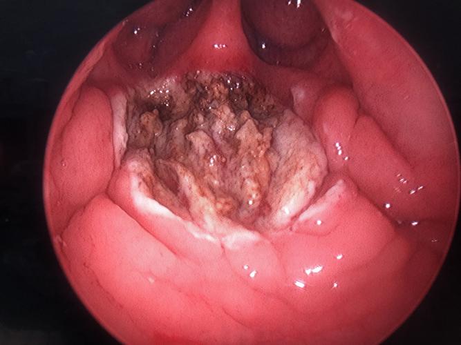 孩子腺样体,扁桃体肥大,切还是不切?