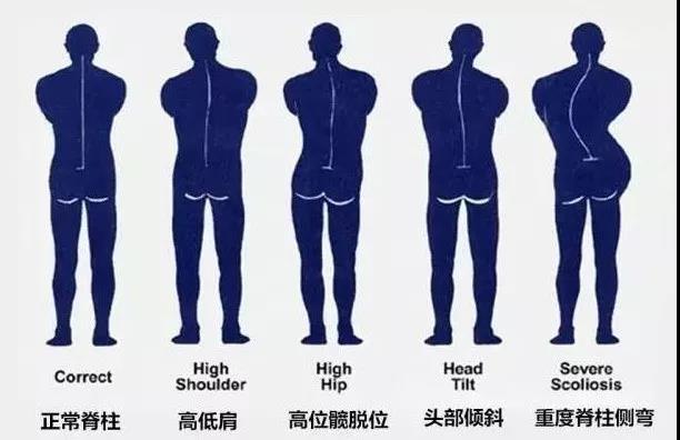 青少年脊柱侧弯的原因可能与遗传,激素影响,生长发育不对称,神经