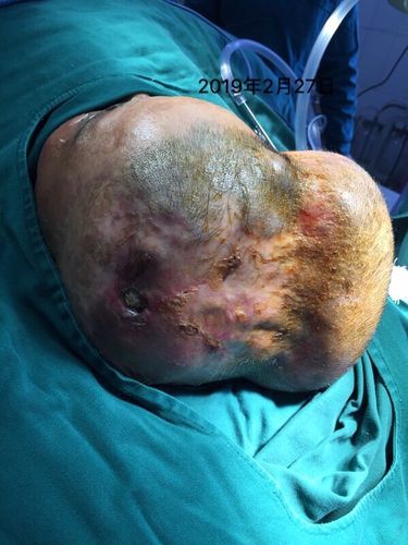 湘西州肿瘤医院成功开展首例"头皮软组织扩张器植入手术"