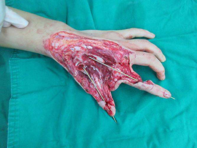 拇,示指Ⅶ缺损缺损 长手指再造