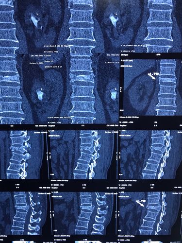 ct示:t12椎体压缩性粉碎性骨折并骨性椎管狭窄严重.
