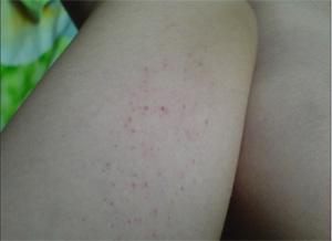 特发性血小板减少性紫癜讲稿