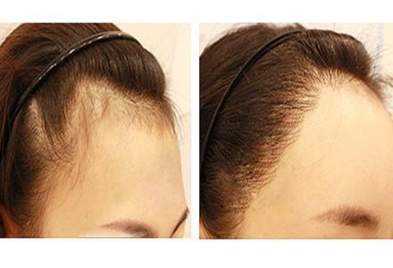 激光发际线脱毛 脱毛与嫩肤的完美结合 冰点发际线脱毛