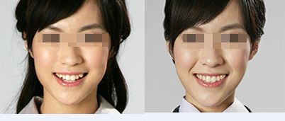 哪种牙齿矫正比较好?