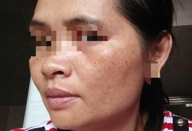 长斑的人,仔细检查下手心这个地方,颜色发青,准是肝斑