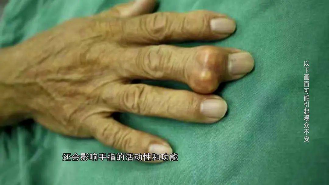 男子手上疯长"大石头"!医生一查:这种病会把