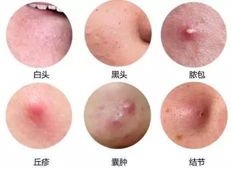 脸上长痤疮是什么原因导致的应该如何改善这种情况