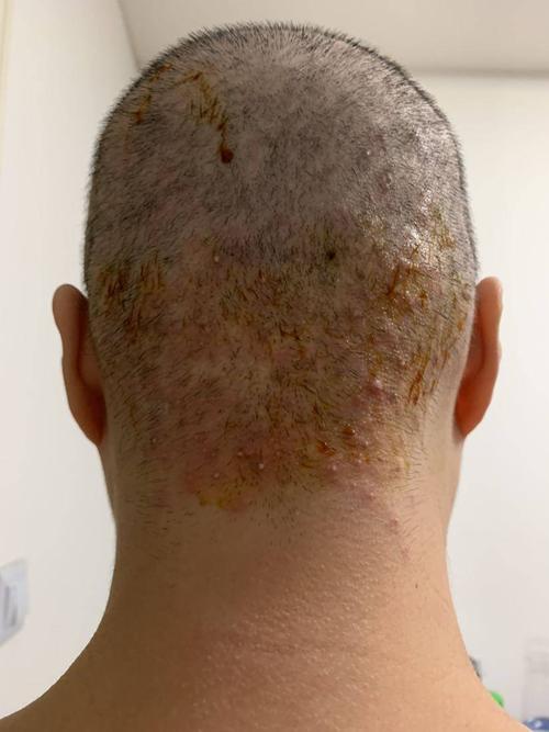 头上的包越来越严重了!周化疗第五次,下周第六次