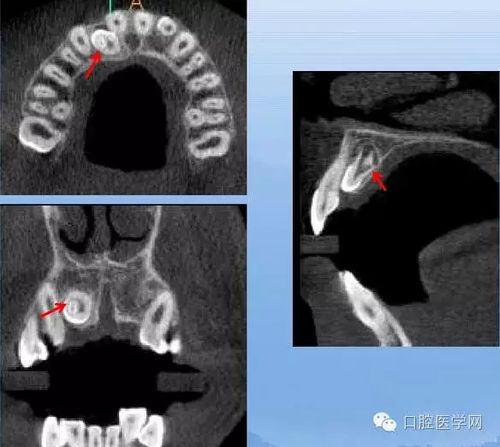 畸形舌侧窝x线表现:舌隆突特别突起,在舌面可见致密高起的小牙尖.