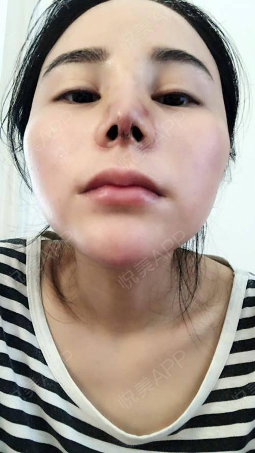 自体肋软骨隆鼻术后4天_硅胶假体隆鼻术后4天_隆鼻术后4天_鼻部术后4