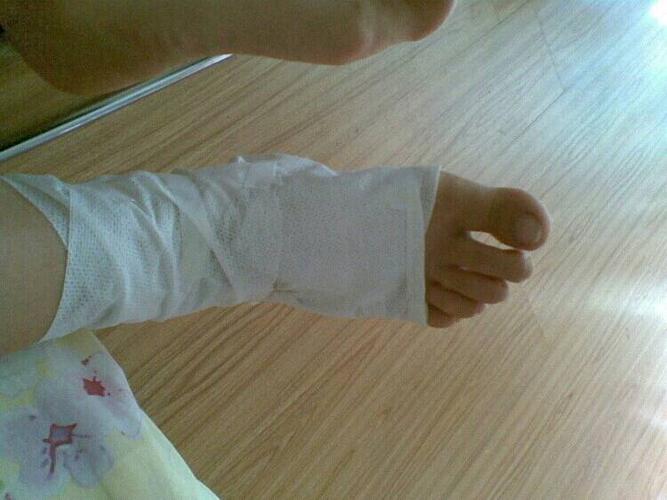 我直接在学校随便包扎了,刚才脚十分痛,拆了绷带整只脚肿了,我明天要