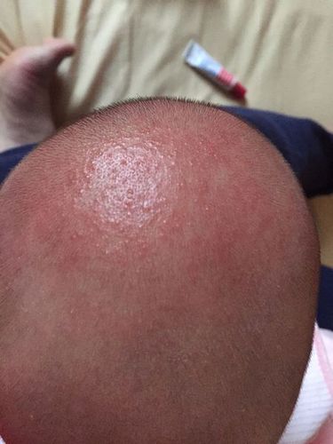 宝宝头皮上长了一片红红一粒一粒的疹子,怎么回事