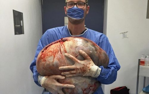 未婚女孩肚里产出64斤「怪胎」