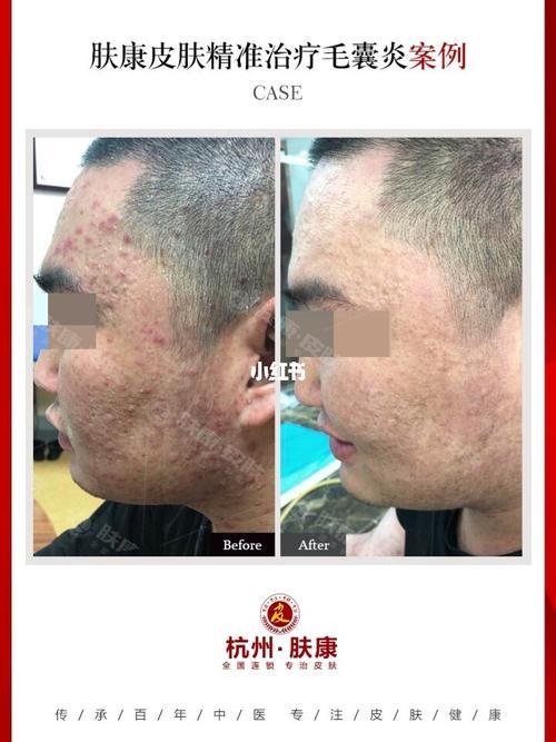 面部毛囊炎属于自身皮脂腺分泌旺盛,局部细_熬夜_皮肤