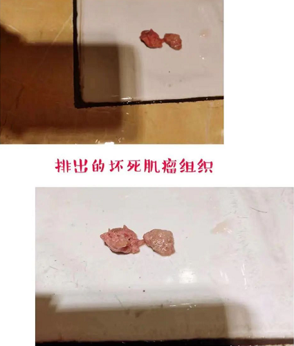 完美消融,坏死肌瘤组织排出