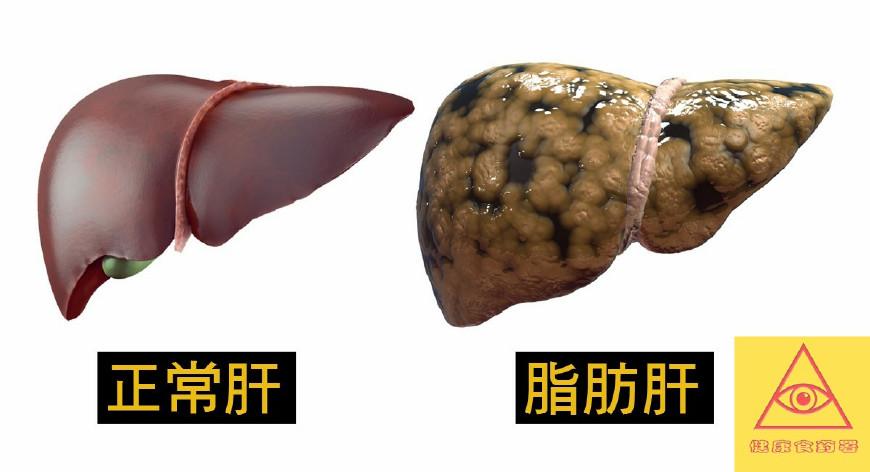 医师公开最佳方法教你逆转脂肪肝
