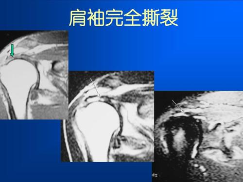 肩袖损伤 肩袖完全撕裂