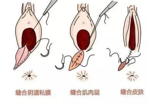 干货!如果你决定顺产,就不得不关注"侧切"的秘密!