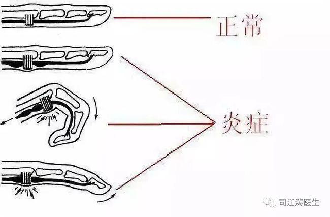 弹响指狭窄性腱鞘炎的一次性治愈方法