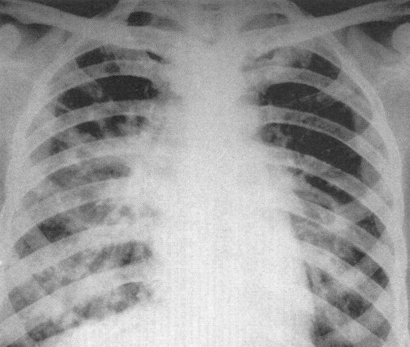 (图) 小叶性干酪性肺炎-胸部x线影像学图鉴-医学