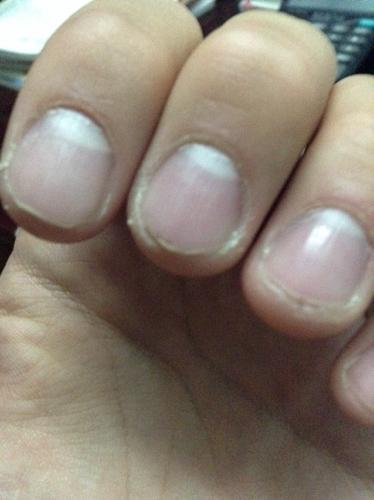 指尖的指甲发白剪了又会出现白的这是什么情况啊