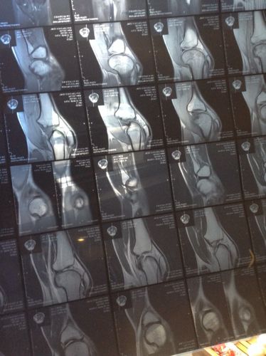 做了核磁 医生说髌骨软化,开了盐酸氨基葡萄糖,让我做