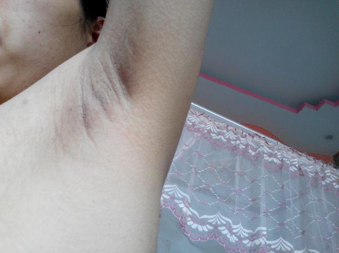 腋窝下有黑线是没洗干净吗